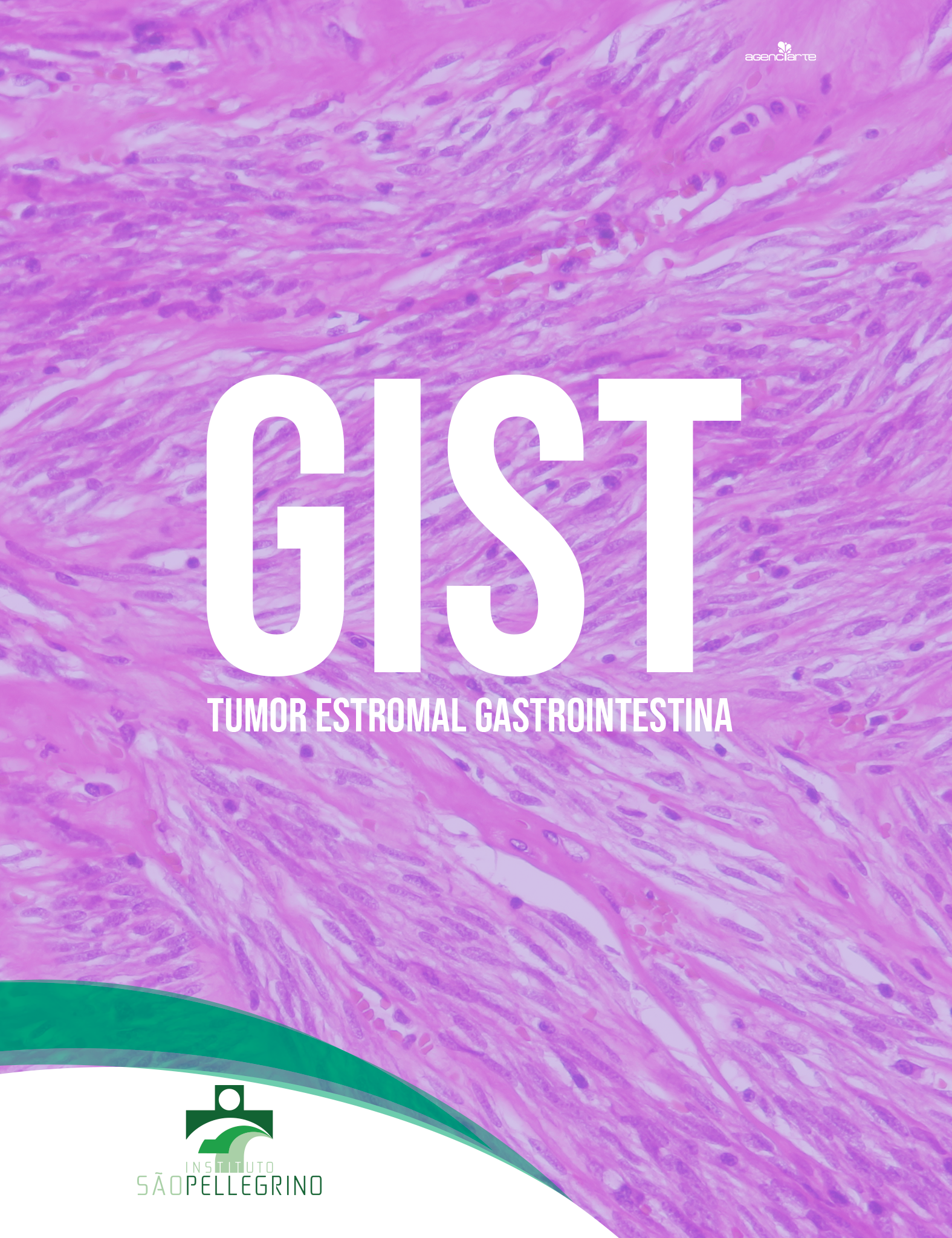 GIST (tumor estromal gastrointestinal)